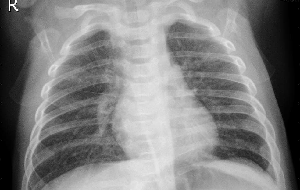 Pneumonia — NIH Chest X-ray14