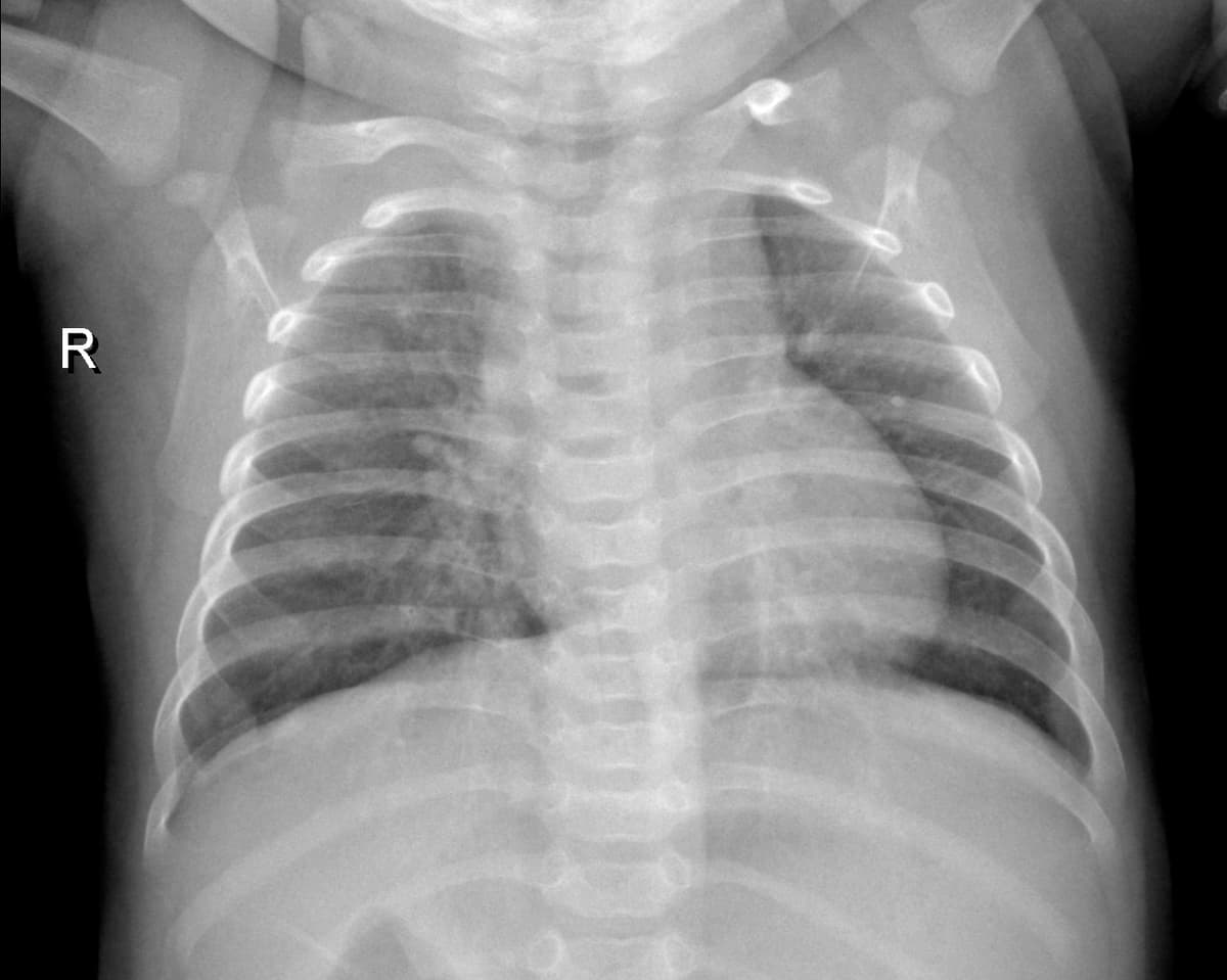 Radiografia Normal — NIH Chest X-ray14