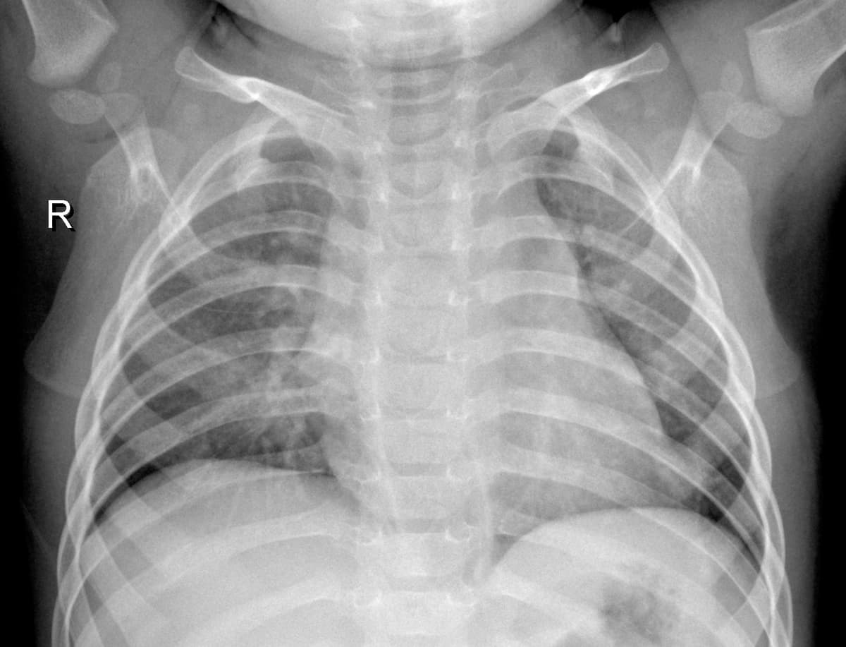 Radiografia Normal — NIH Chest X-ray14