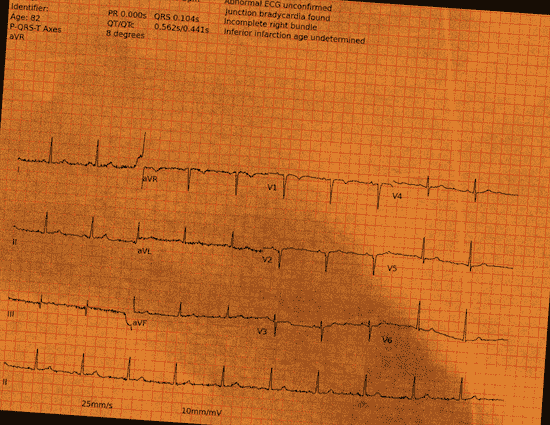Normal ECG — PTB-XL