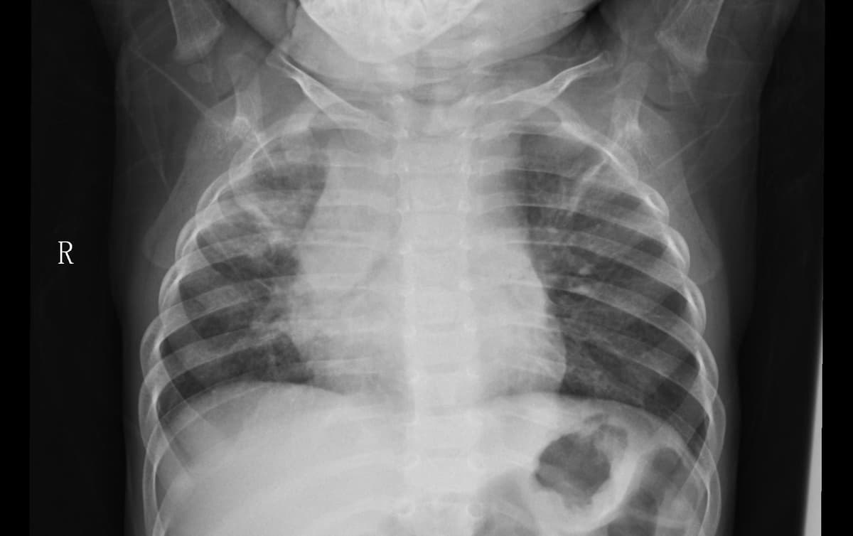 Pneumonia — NIH Chest X-ray14