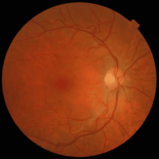 No Diabetic Retinopathy — MESSIDOR-2
