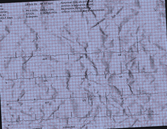 Normal ECG — PTB-XL