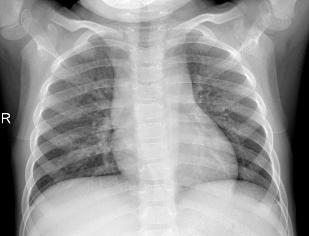 Radiografia Normal — NIH Chest X-ray14