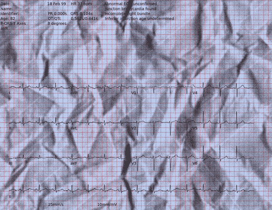 Normal ECG — PTB-XL