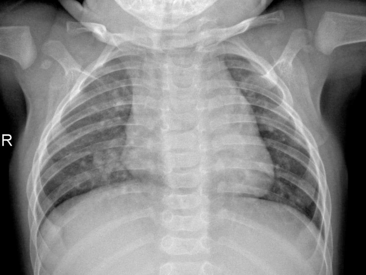 Radiografia Normal — NIH Chest X-ray14