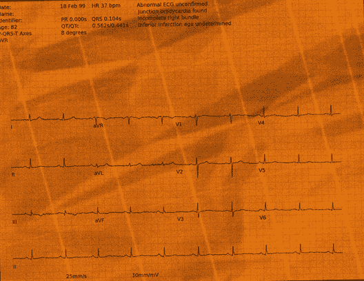 Normal ECG — PTB-XL