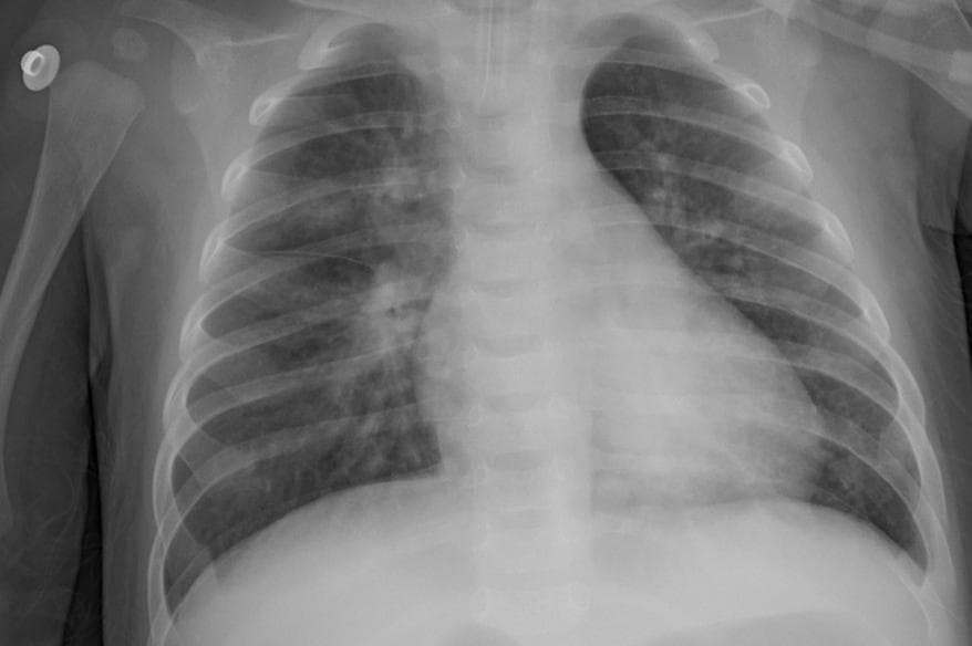 Pneumonia — NIH Chest X-ray14