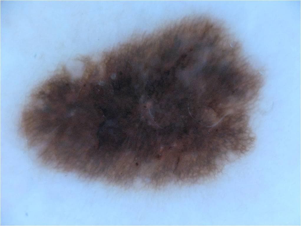 Seborrheic Keratosis — ISIC Archive