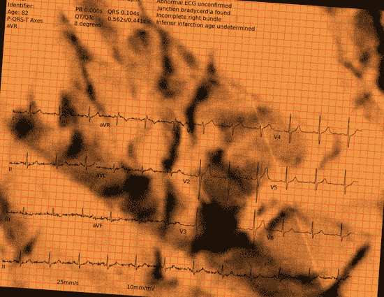 Normal ECG — PTB-XL