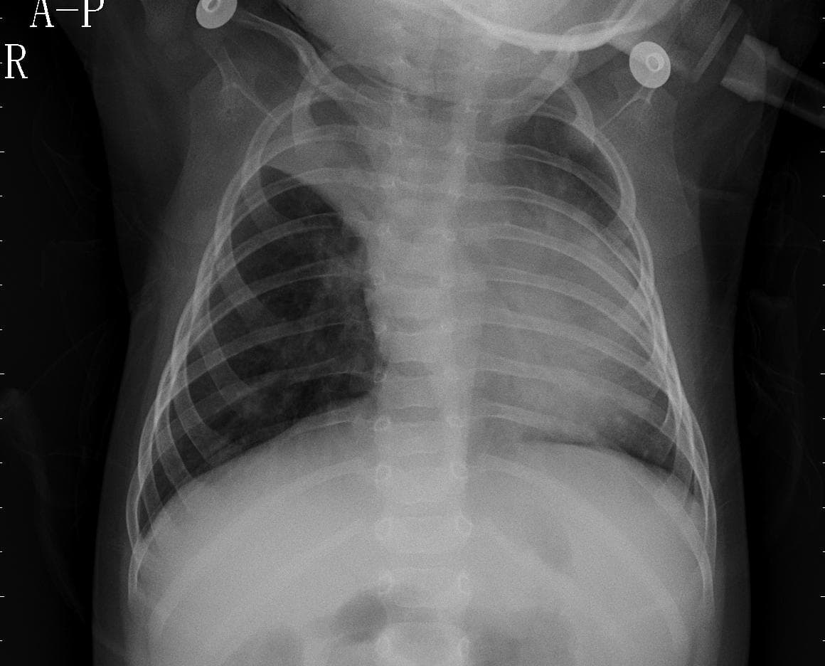 Pneumonia — NIH Chest X-ray14
