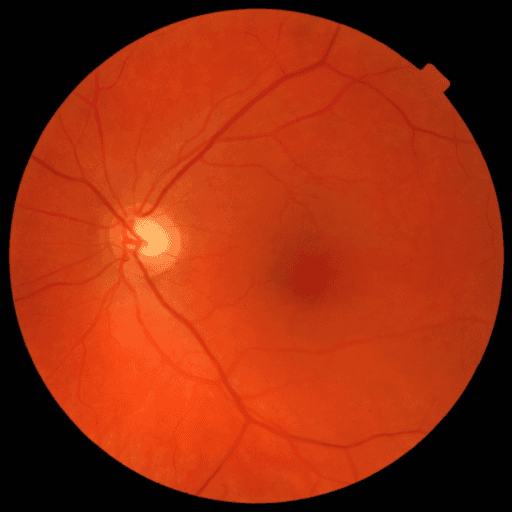 No Diabetic Retinopathy — MESSIDOR-2