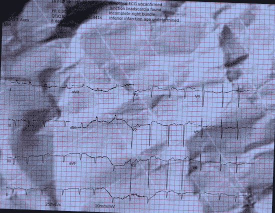 Normal ECG — PTB-XL