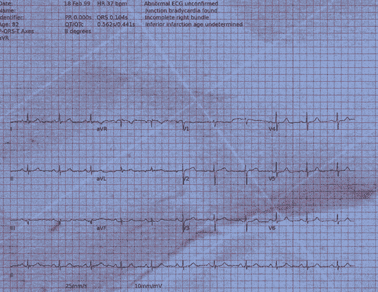 Normal ECG — PTB-XL