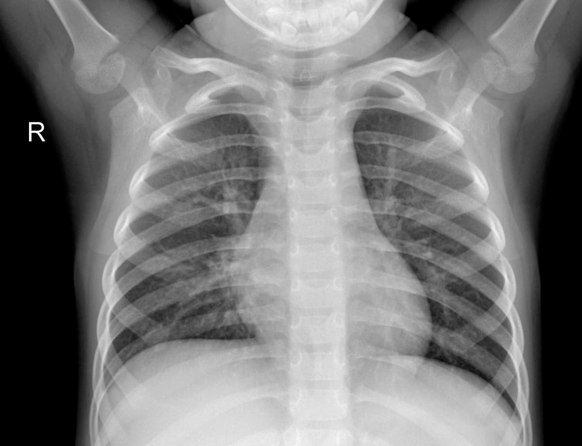 Radiografia Normal — NIH Chest X-ray14