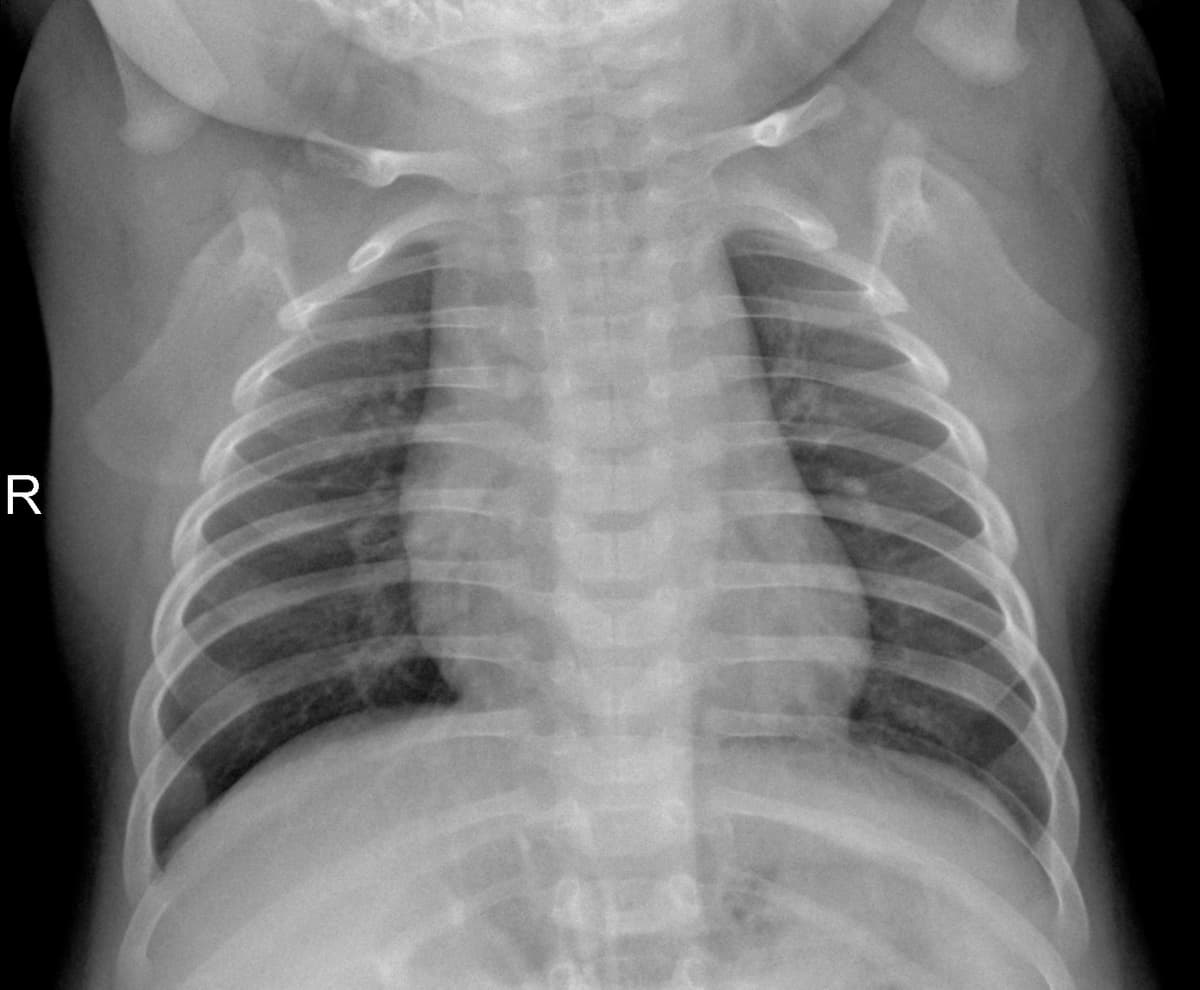 Radiografia Normal — NIH Chest X-ray14