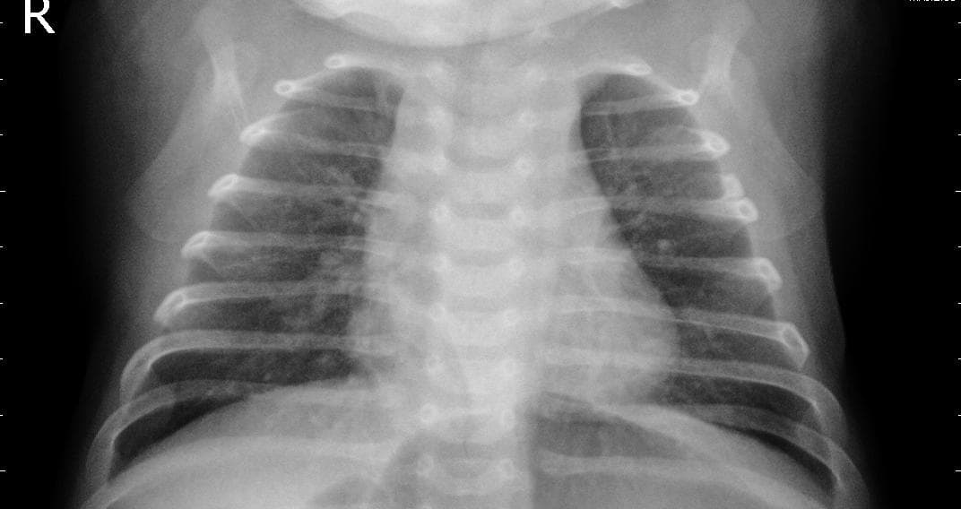 Pneumonia — NIH Chest X-ray14