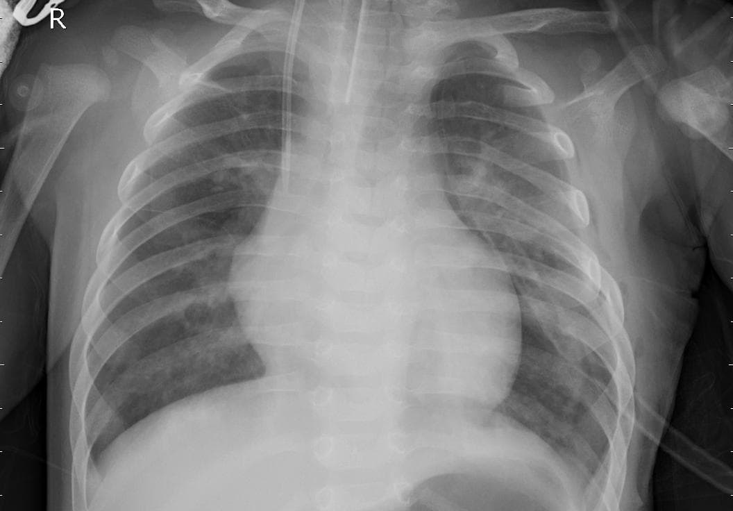 Pneumonia — NIH Chest X-ray14
