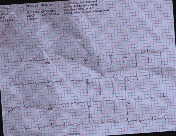 Normal ECG — PTB-XL