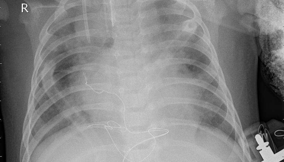 Pneumonia — NIH Chest X-ray14