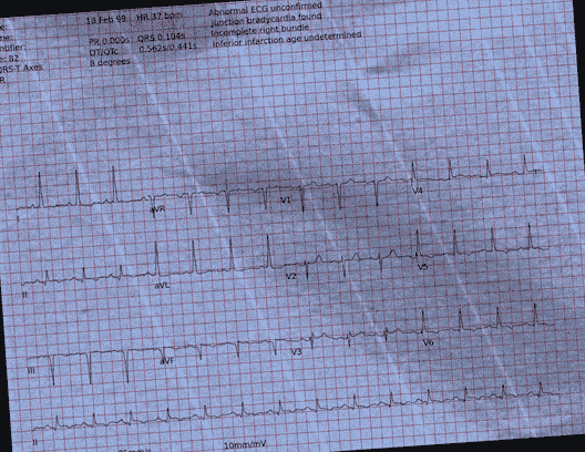 Normal ECG — PTB-XL