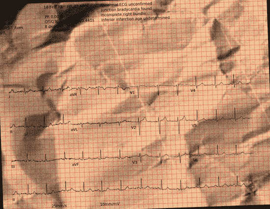 Normal ECG — PTB-XL