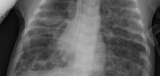 Pneumonia — NIH Chest X-ray14