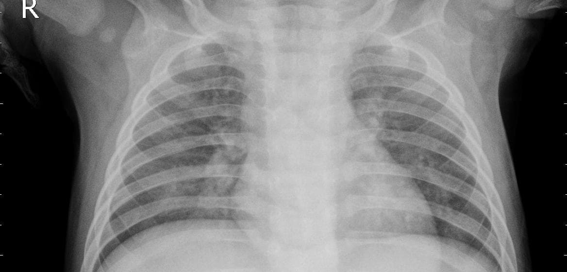 Pneumonia — NIH Chest X-ray14