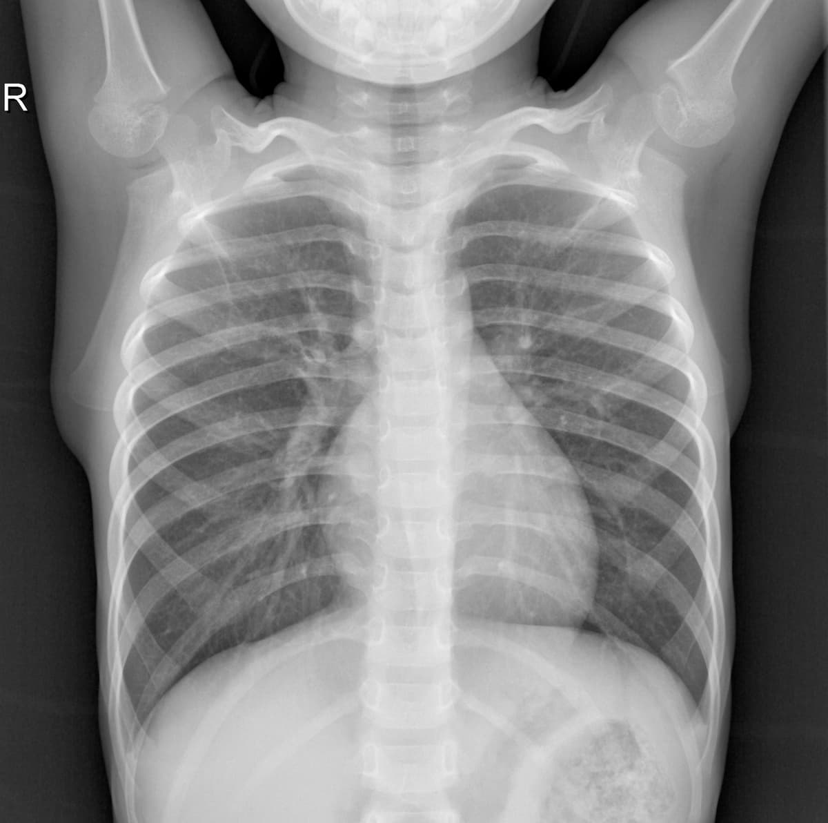 Radiografia Normal — NIH Chest X-ray14