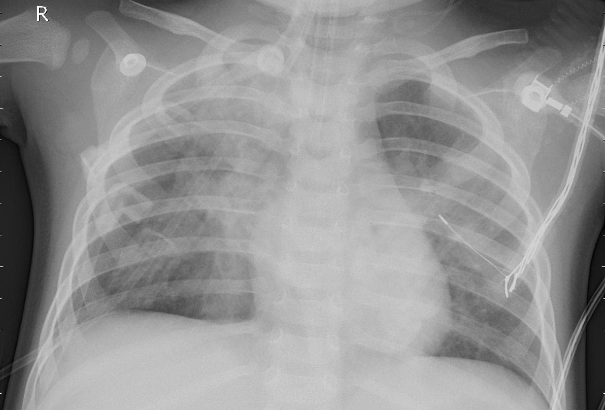Pneumonia — NIH Chest X-ray14