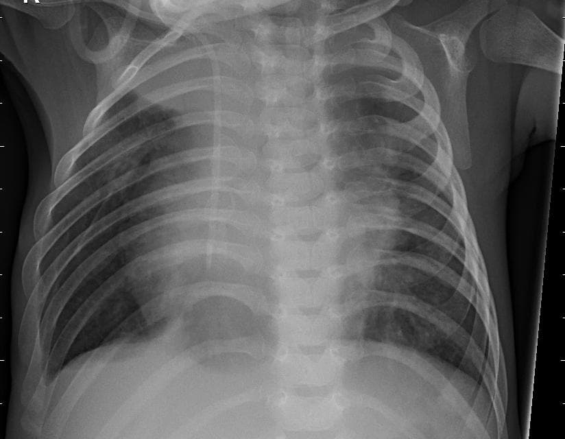 Pneumonia — NIH Chest X-ray14