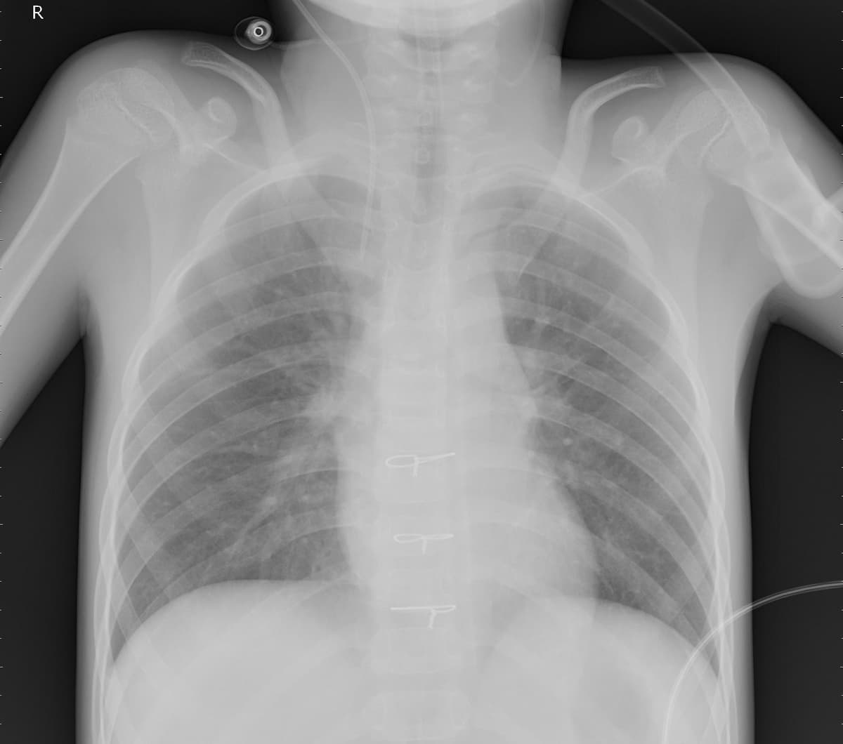 Pneumonia — NIH Chest X-ray14
