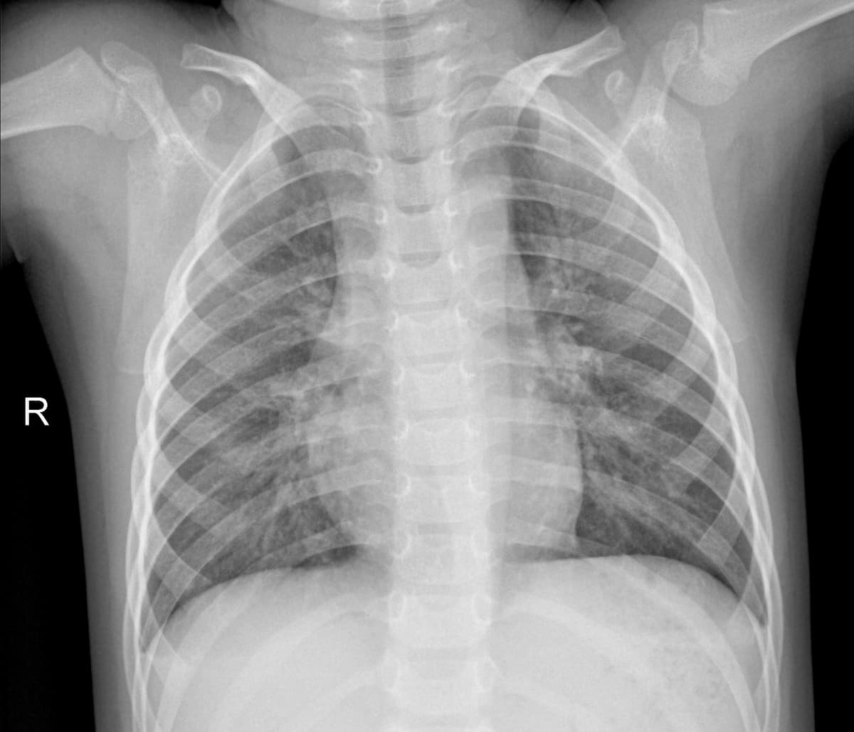 Radiografia Normal — NIH Chest X-ray14