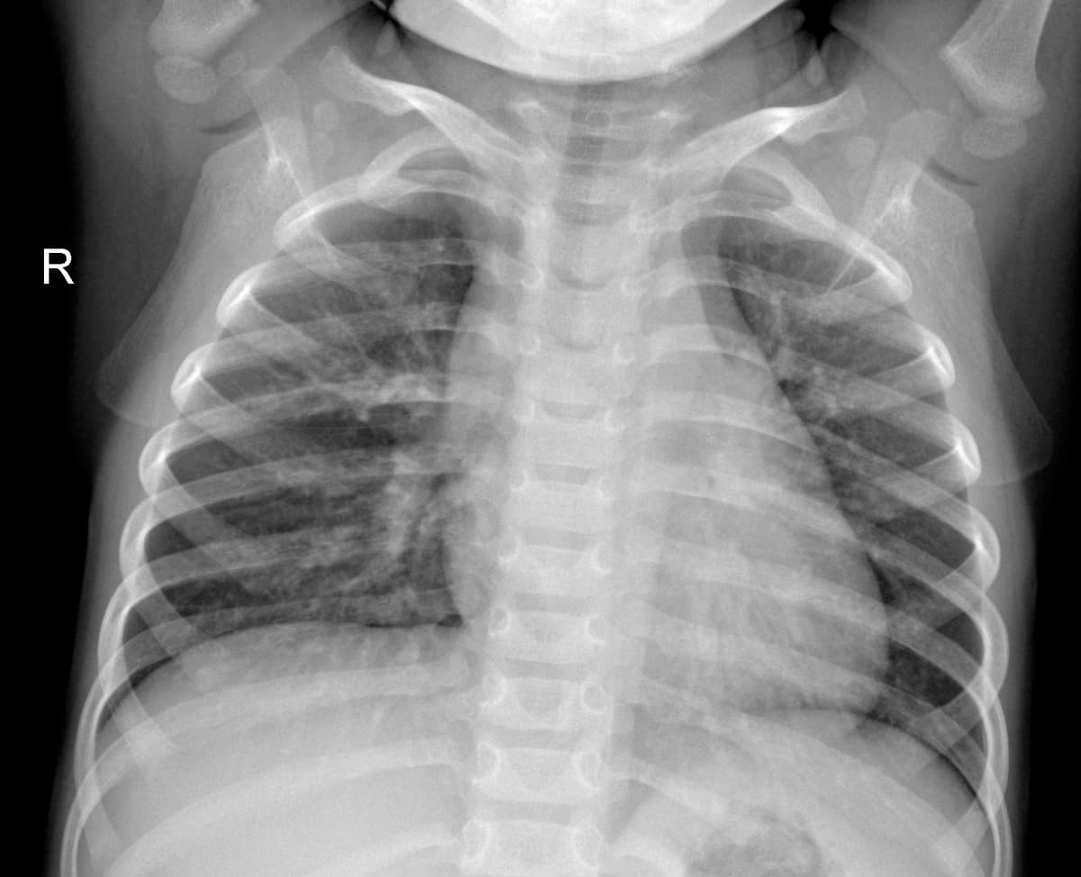 Radiografia Normal — NIH Chest X-ray14