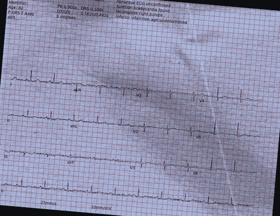 Normal ECG — PTB-XL