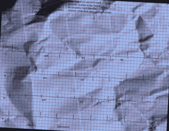 Normal ECG — PTB-XL