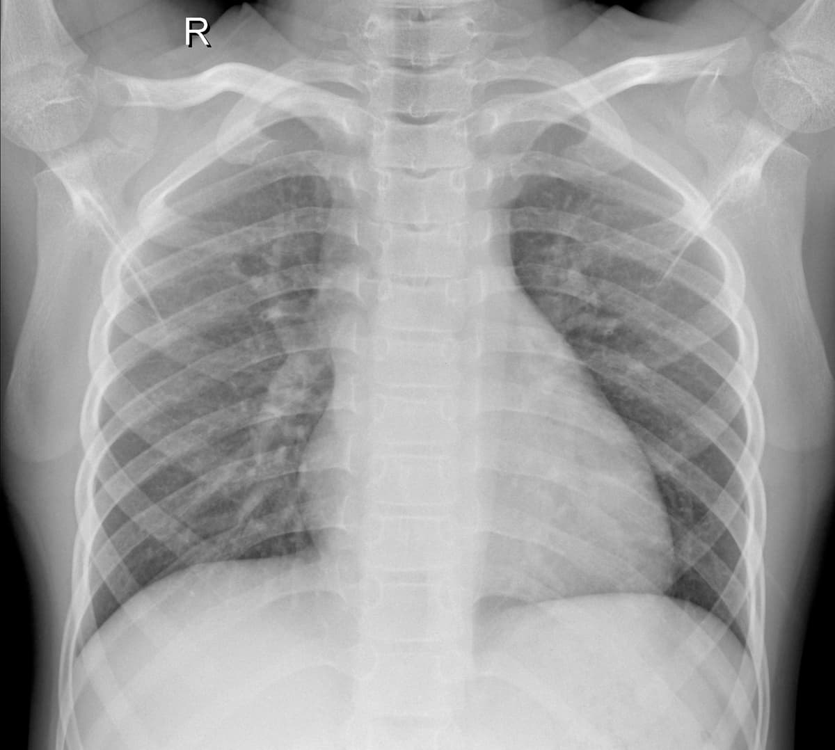 Radiografia Normal — NIH Chest X-ray14