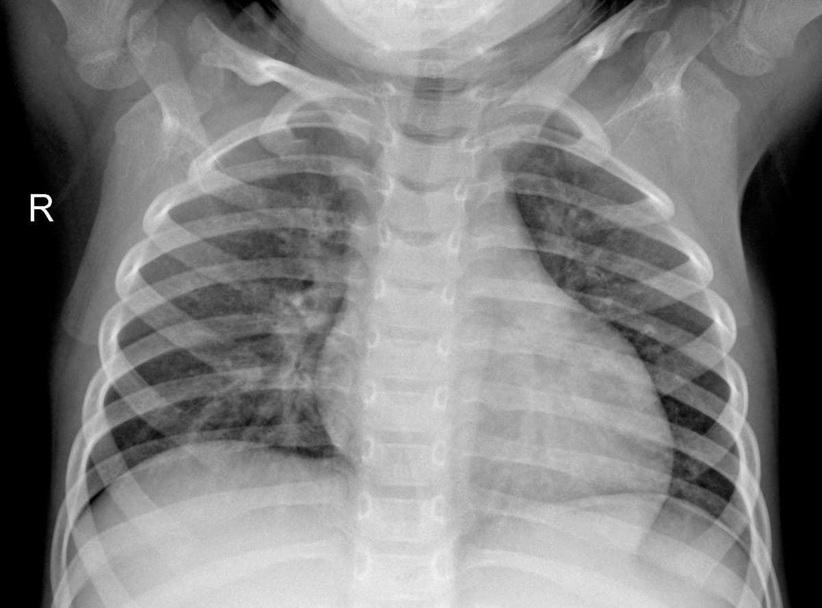Radiografia Normal — NIH Chest X-ray14