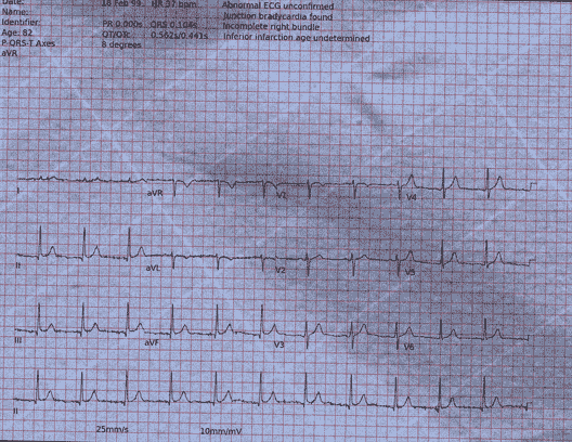 Normal ECG — PTB-XL