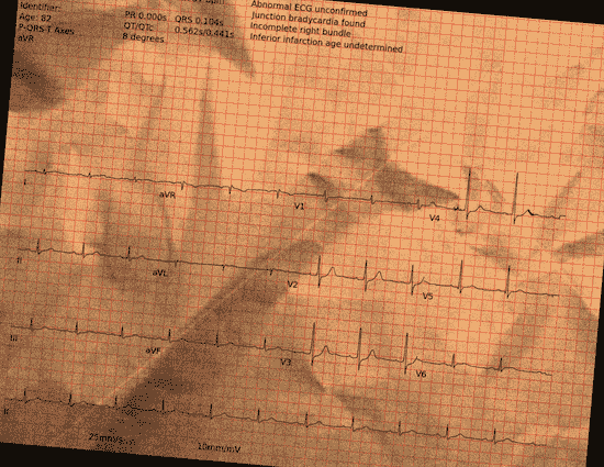 Normal ECG — PTB-XL