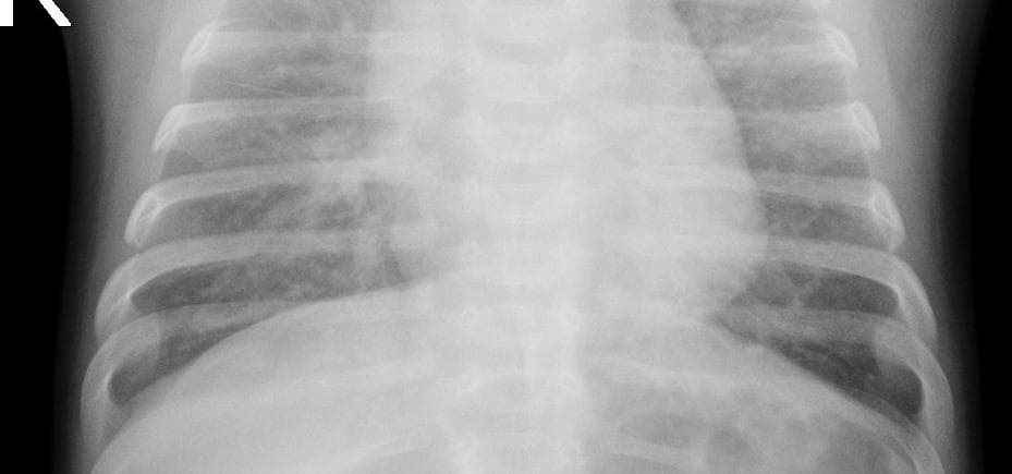 Pneumonia — NIH Chest X-ray14