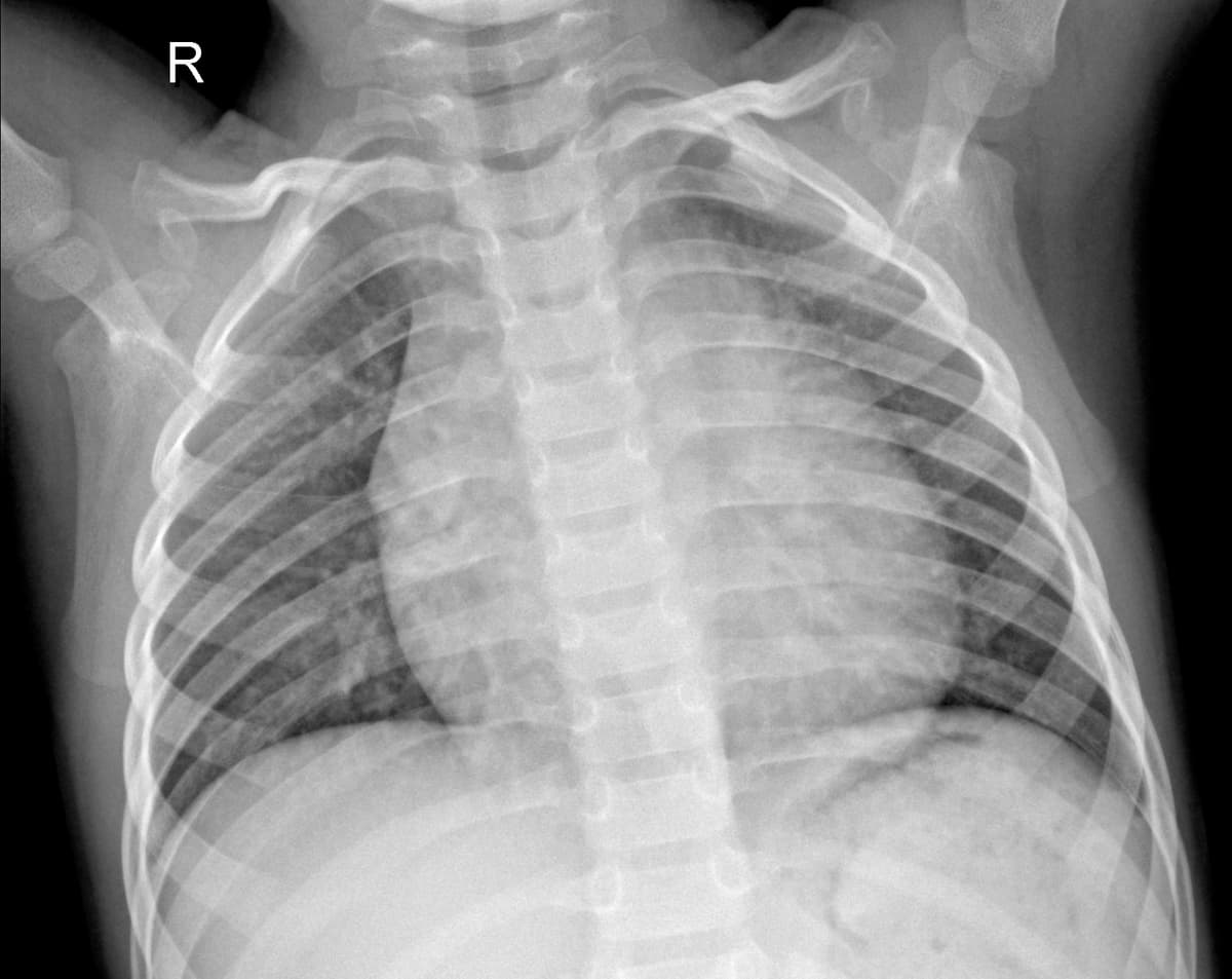 Radiografia Normal — NIH Chest X-ray14