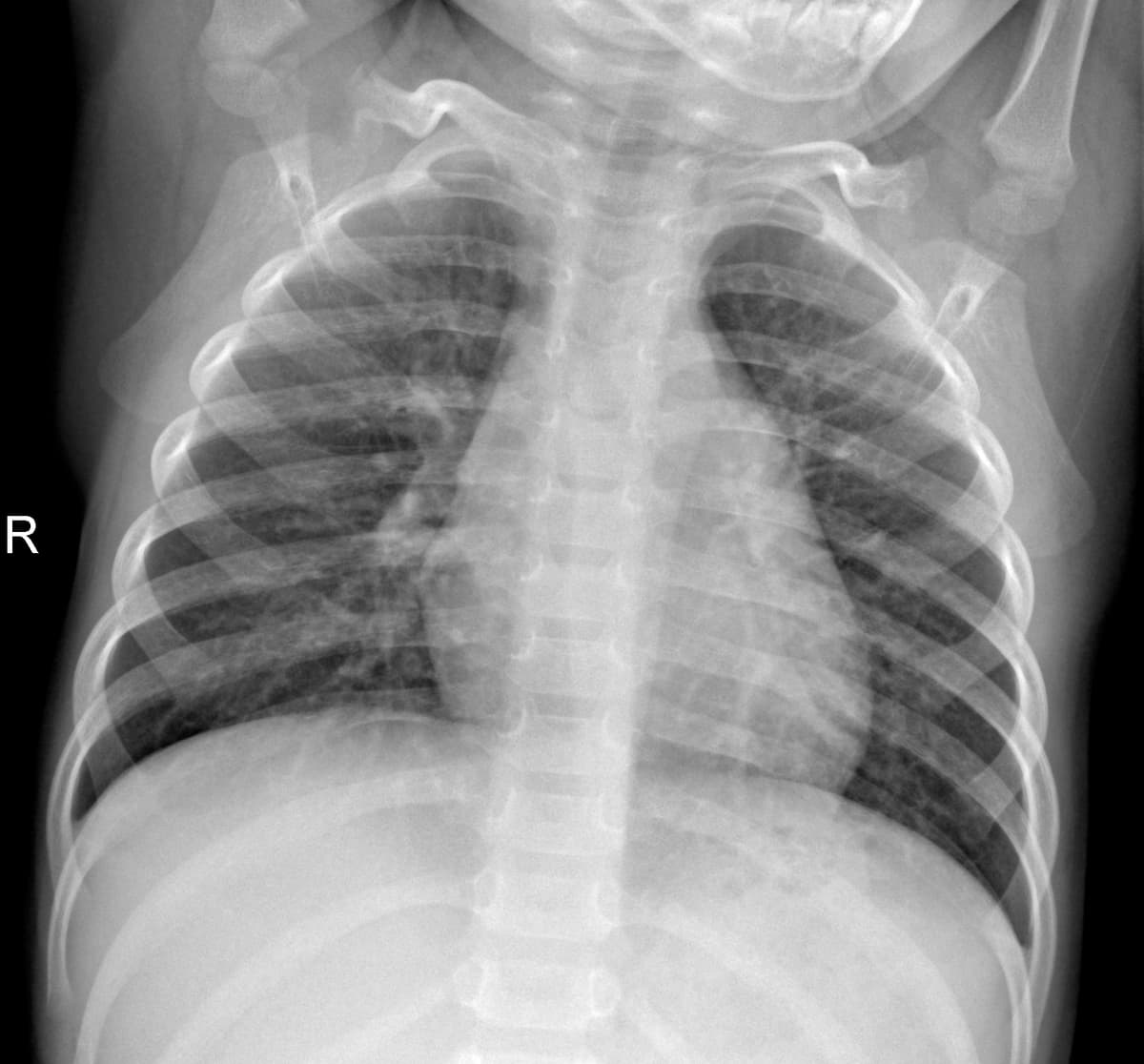 Radiografia Normal — NIH Chest X-ray14