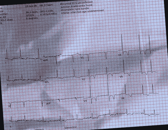 Normal ECG — PTB-XL