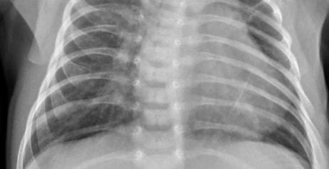 Pneumonia — NIH Chest X-ray14