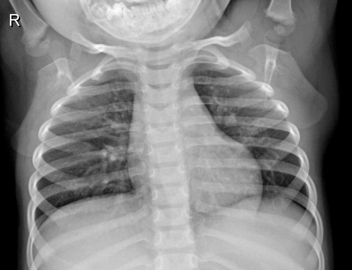 Radiografia Normal — NIH Chest X-ray14