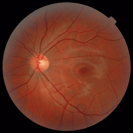 No Diabetic Retinopathy — MESSIDOR-2