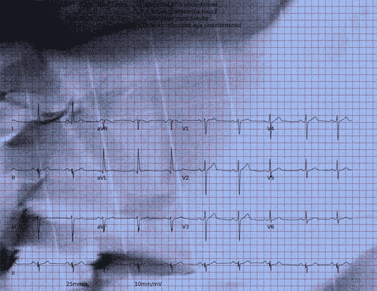 Normal ECG — PTB-XL