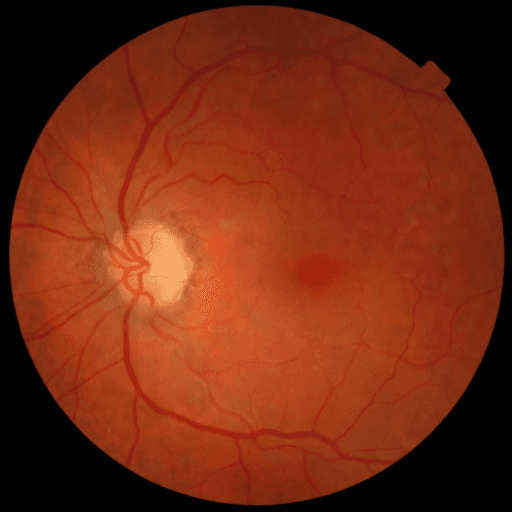 No Diabetic Retinopathy — MESSIDOR-2