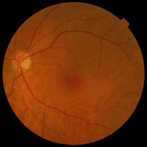 No Diabetic Retinopathy — MESSIDOR-2